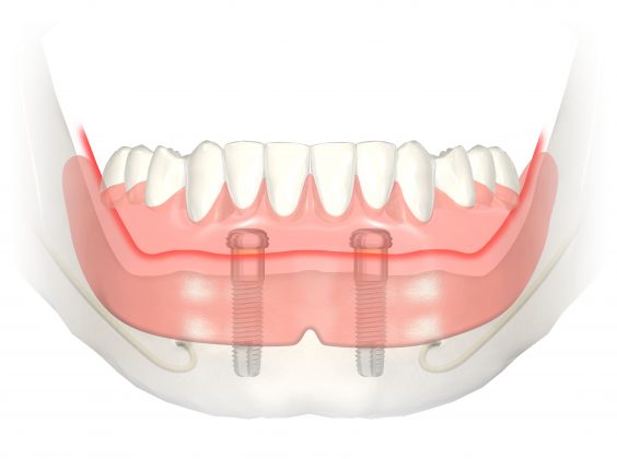 Dantų protezas įtvirtintas ant dviejų implantų