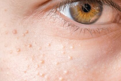 Ar aplink jūsų akis yra baltų taškelių? Panaikinkite juos natūraliomis priemonėmis!