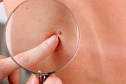 Statistika rodo, kad bazalioma, arba odos vėžys, yra dažniausia iš vėžinių ligų – ji sudaro 25 proc. visų onkologinių ligų ir 75 proc. visų odos vėžio atvejų. Medikai primena, jog jei pats pacientas nepastebės pirmųjų požymių ir laiku nesikreips pagalbos, specialistai gali būti bejėgiai.