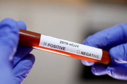 Norintiems išsitirti dėl koronaviruso, testus atlikti galima ir mokamai privačiose laboratorijose – tą daryti leista nuo gegužės pradžios, BNS patvirtino Sveikatos apsaugos ministerija.